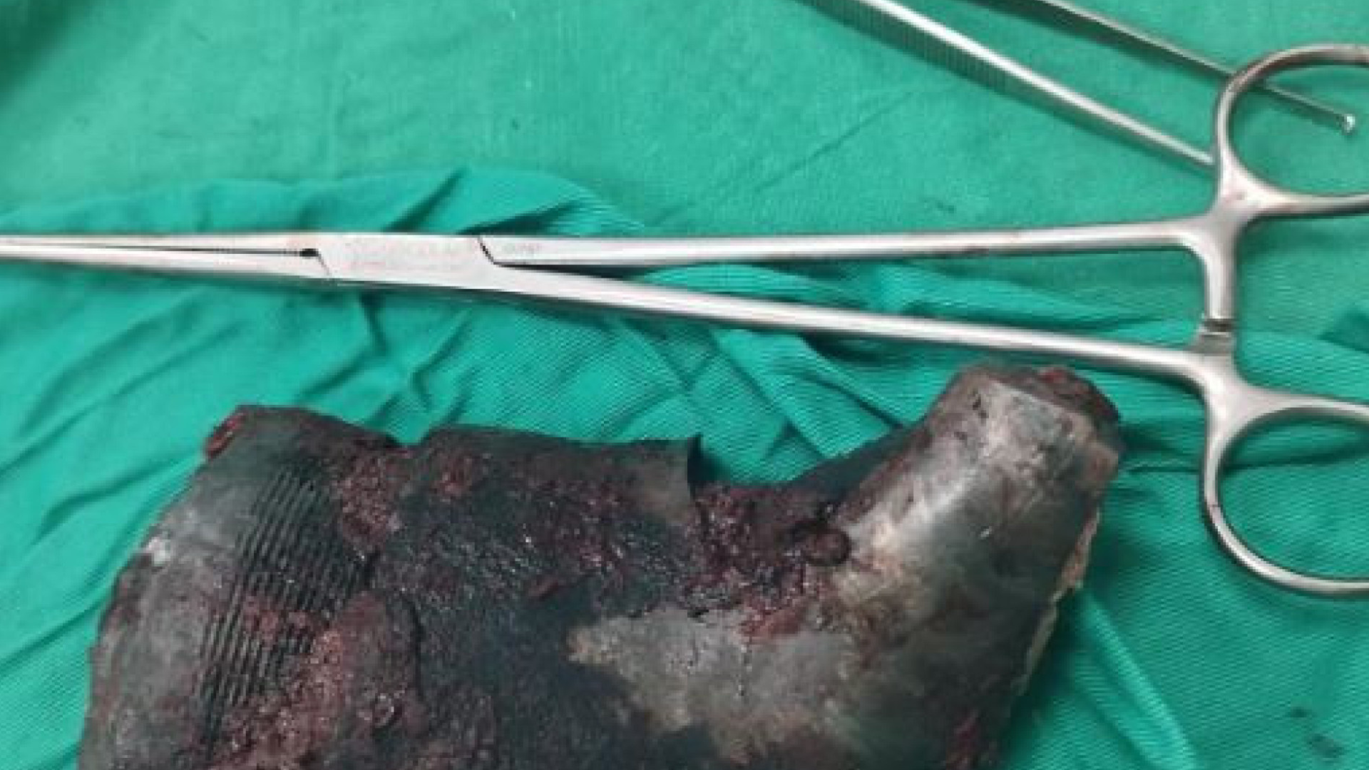 portal plural médicos em gaza removem estilhaço de um quilo de homem palestino