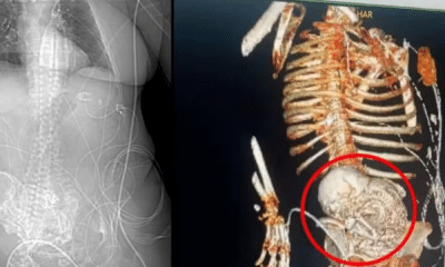 portal plural idosa de 86 anos descobre feto calcificado após mais de 5 décadas
