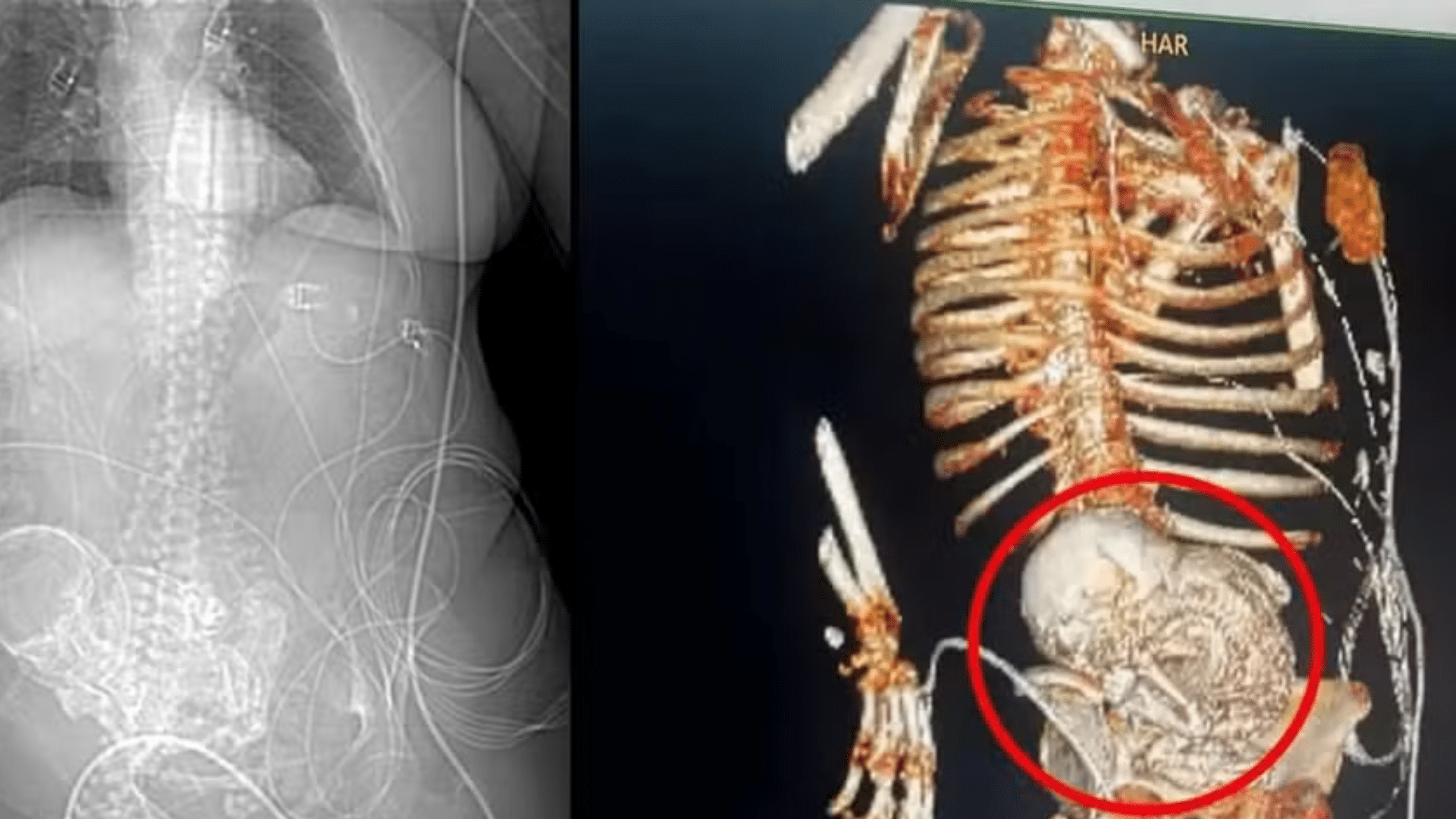 portal plural idosa de 86 anos descobre feto calcificado após mais de 5 décadas
