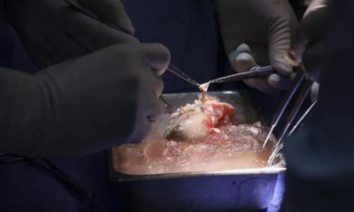 portal plural primeiro transplante de rim de porco para paciente vivo é realizado com sucesso nos eua