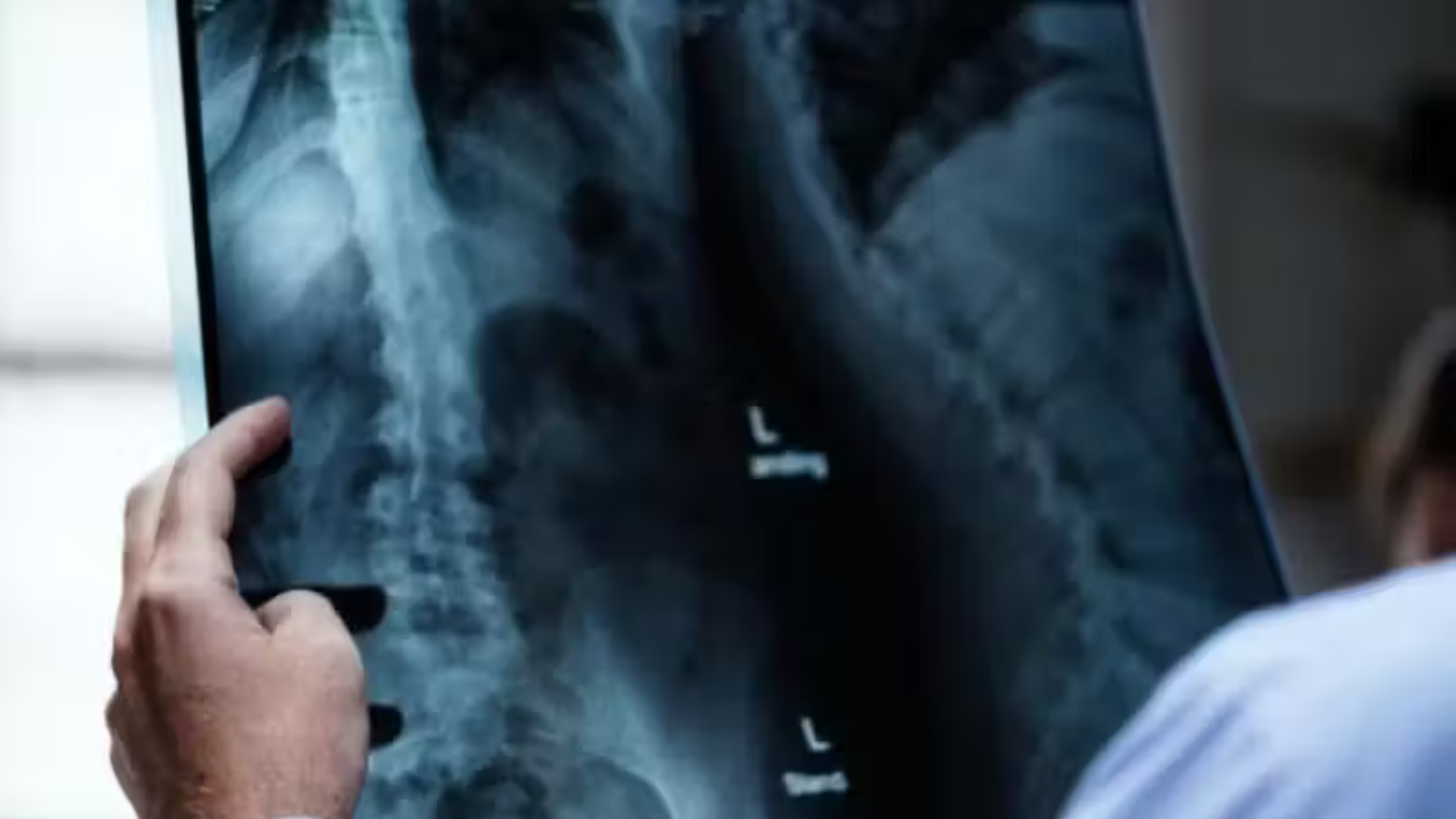 portal plural medicamento inédito para câncer de pulmão aumenta em 7 anos a sobrevida de pacientes