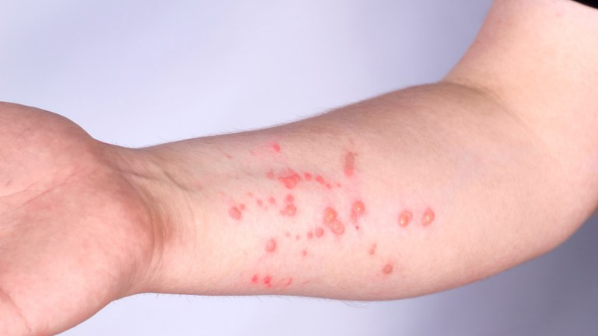 portal plural mpox entenda o que é a doença e as formas de prevenção