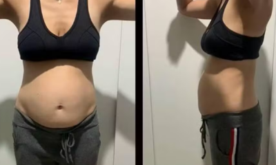 portal plural diástase abdominal entenda em 10 pontos a condição que faz a barriga das mulheres aumentar