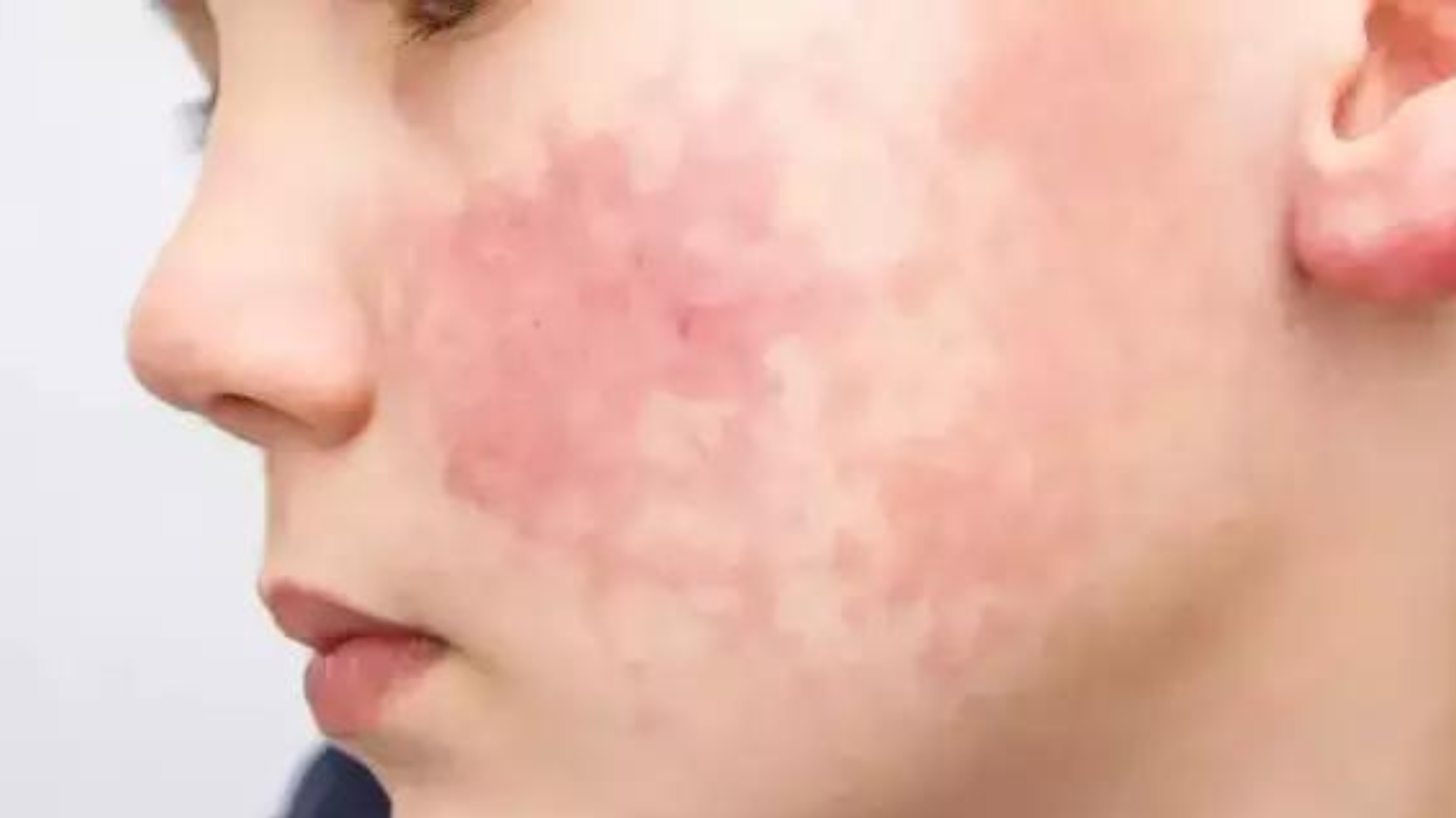 portal plural médica explica os sintomas da celulite facial