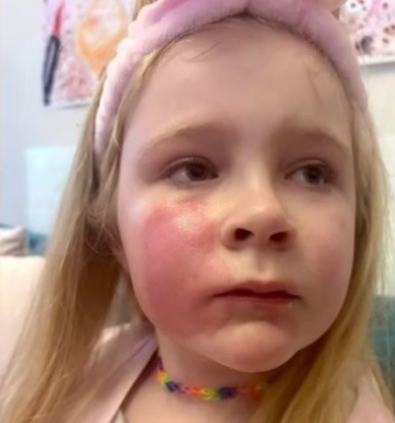 portal plural criança tem reação alérgica no rosto após beijo da mãe. entenda